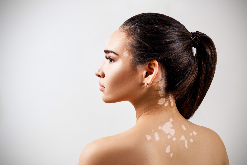 Vitiligo hastaları hangi güneş kremini kullanmalı? 